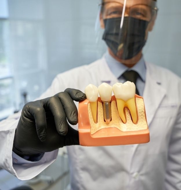 _Dental Implants in Alameda
